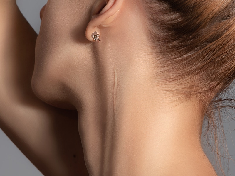 Collagen Peel Newport Beach, CA